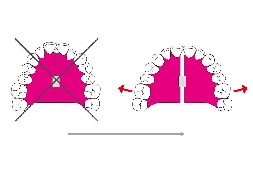 拡大症によって、歯列を側方に拡大し、歯を並べるスペースを作る