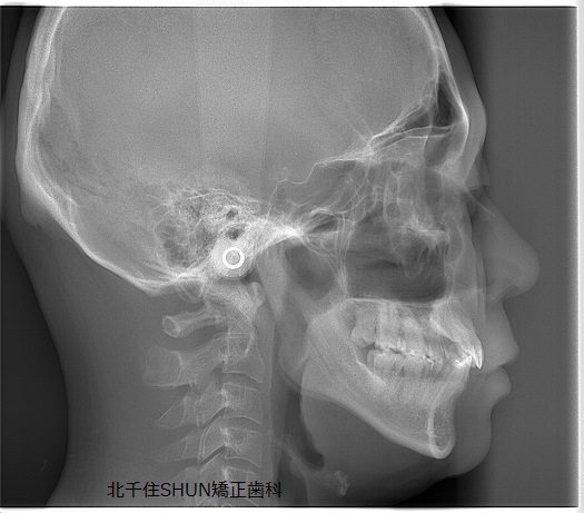 セファログラム 頭部x線規格写真 とは 北千住shun矯正歯科